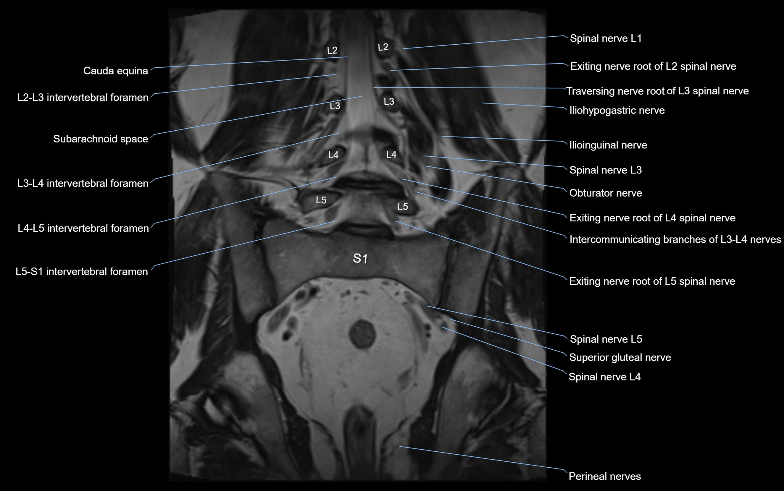 MR lumbosacral plexus cross sectional anatomy 3T  radiology  image-img-09001-00039.webp